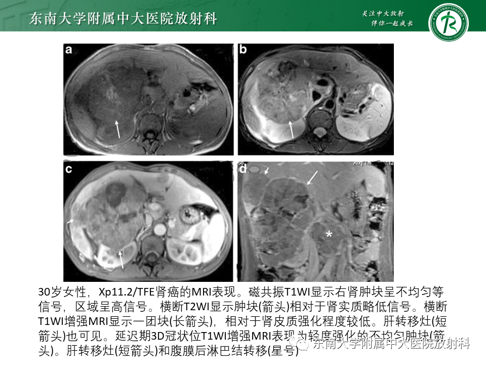 影像PPT - 【PPT】Xp11.2易位/TFE3基因融合相关性肾癌-14