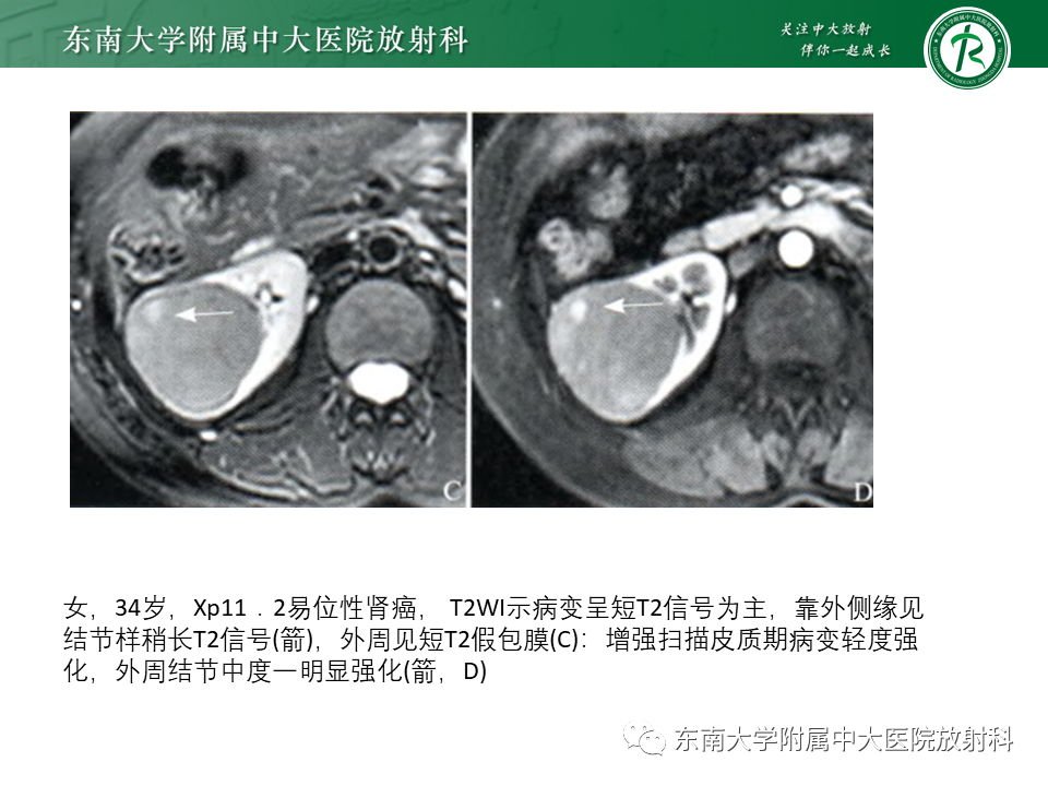 影像PPT - 【PPT】Xp11.2易位/TFE3基因融合相关性肾癌-15