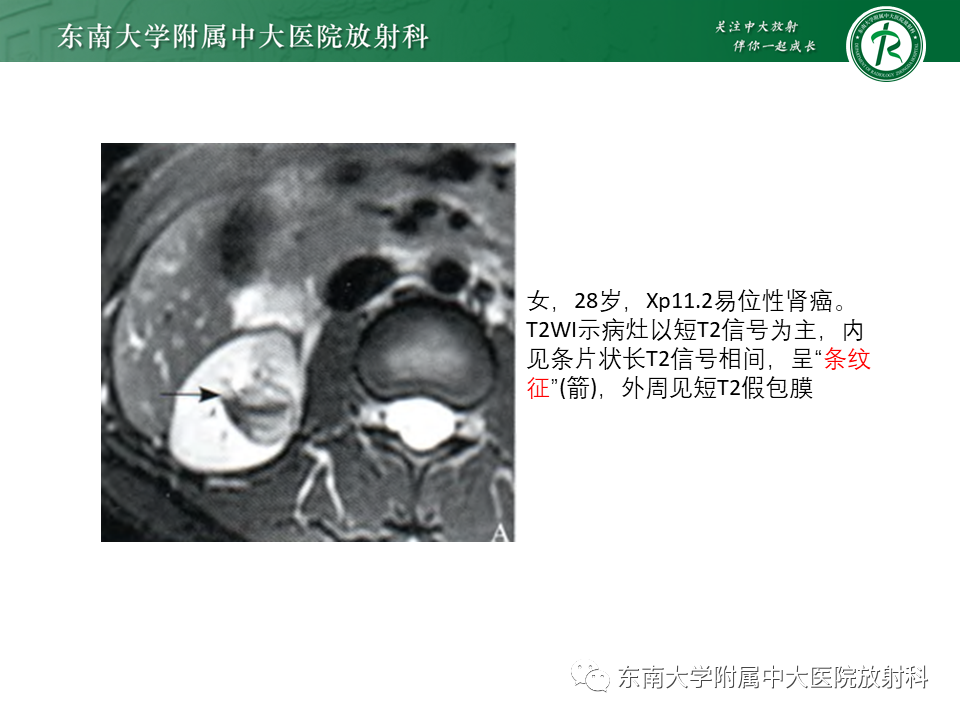 影像PPT - 【PPT】Xp11.2易位/TFE3基因融合相关性肾癌-16