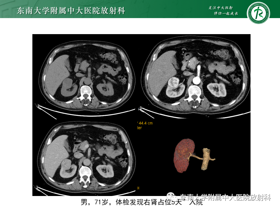 影像PPT - 【PPT】Xp11.2易位/TFE3基因融合相关性肾癌-19