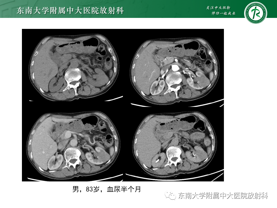影像PPT - 【PPT】Xp11.2易位/TFE3基因融合相关性肾癌-23
