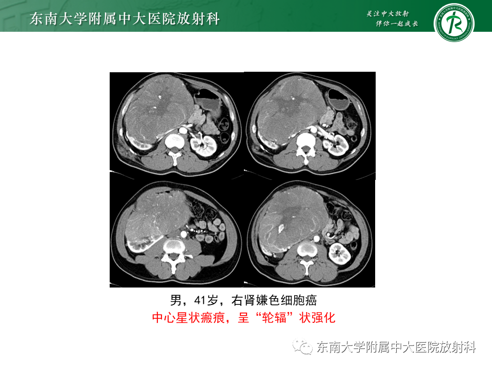 影像PPT - 【PPT】Xp11.2易位/TFE3基因融合相关性肾癌-26