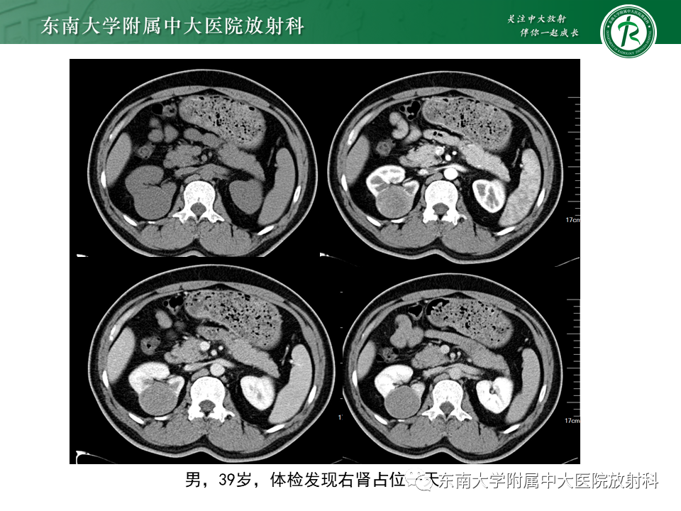 影像PPT - 【PPT】Xp11.2易位/TFE3基因融合相关性肾癌-27
