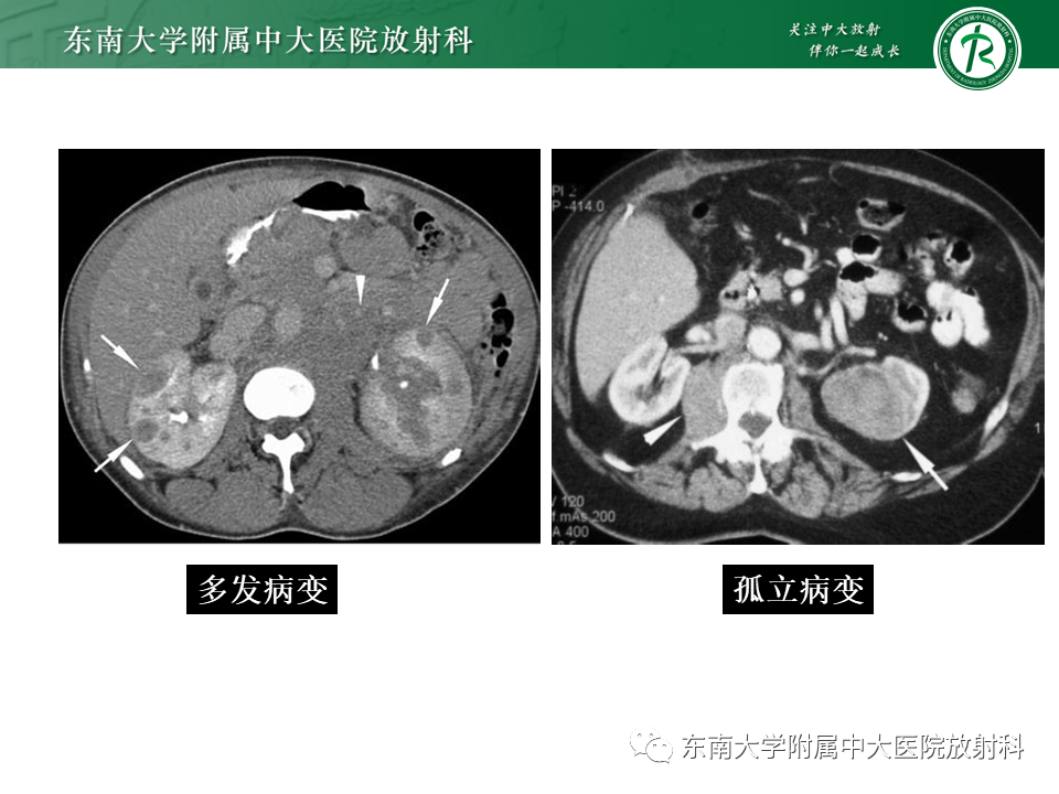 影像PPT - 【PPT】Xp11.2易位/TFE3基因融合相关性肾癌-32