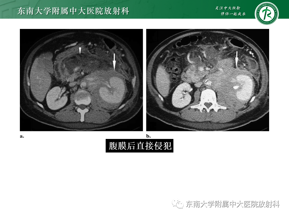 影像PPT - 【PPT】Xp11.2易位/TFE3基因融合相关性肾癌-33