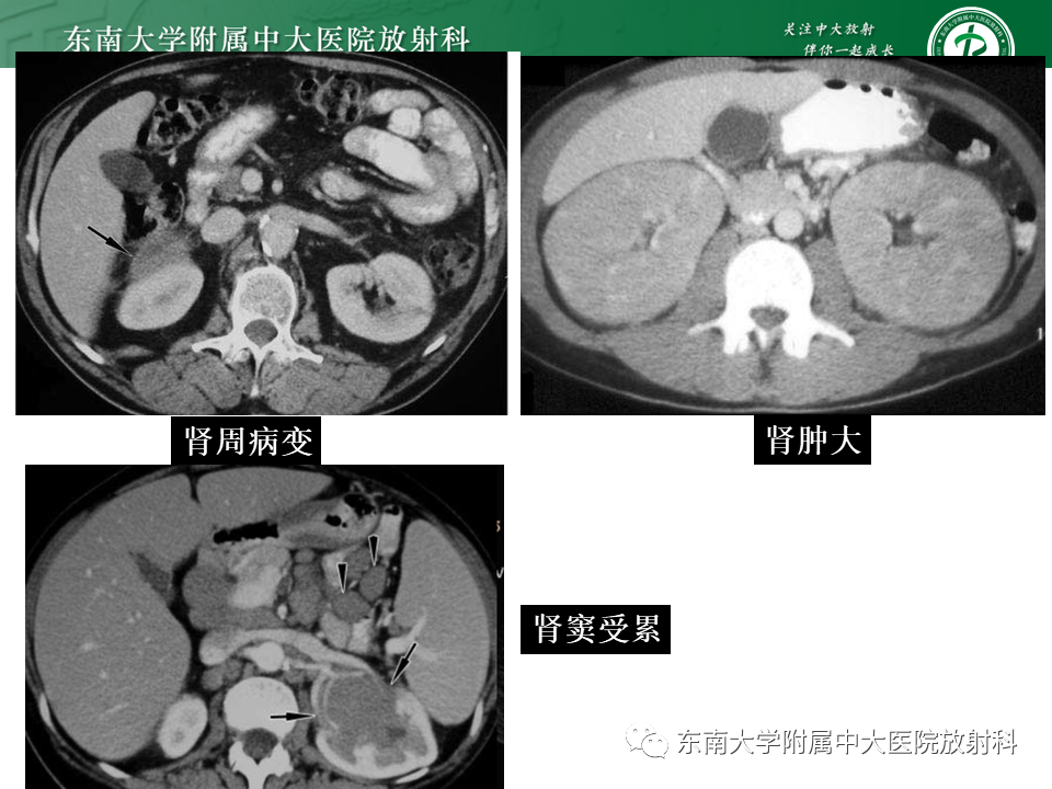 影像PPT - 【PPT】Xp11.2易位/TFE3基因融合相关性肾癌-34