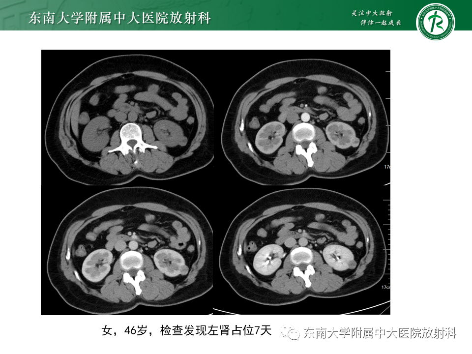 影像PPT - 【PPT】Xp11.2易位/TFE3基因融合相关性肾癌-37