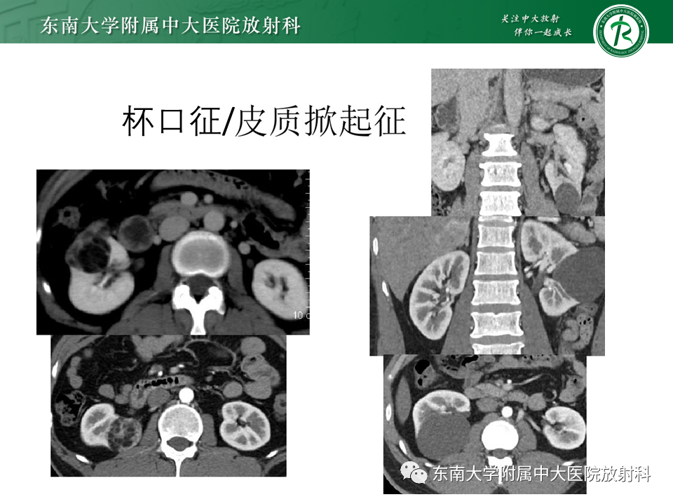 影像PPT - 【PPT】Xp11.2易位/TFE3基因融合相关性肾癌-39