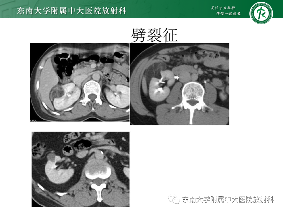 影像PPT - 【PPT】Xp11.2易位/TFE3基因融合相关性肾癌-40