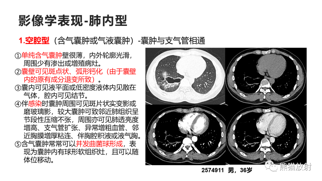 影像PPT - 【病例】支气管源性囊肿2例CT影像-30