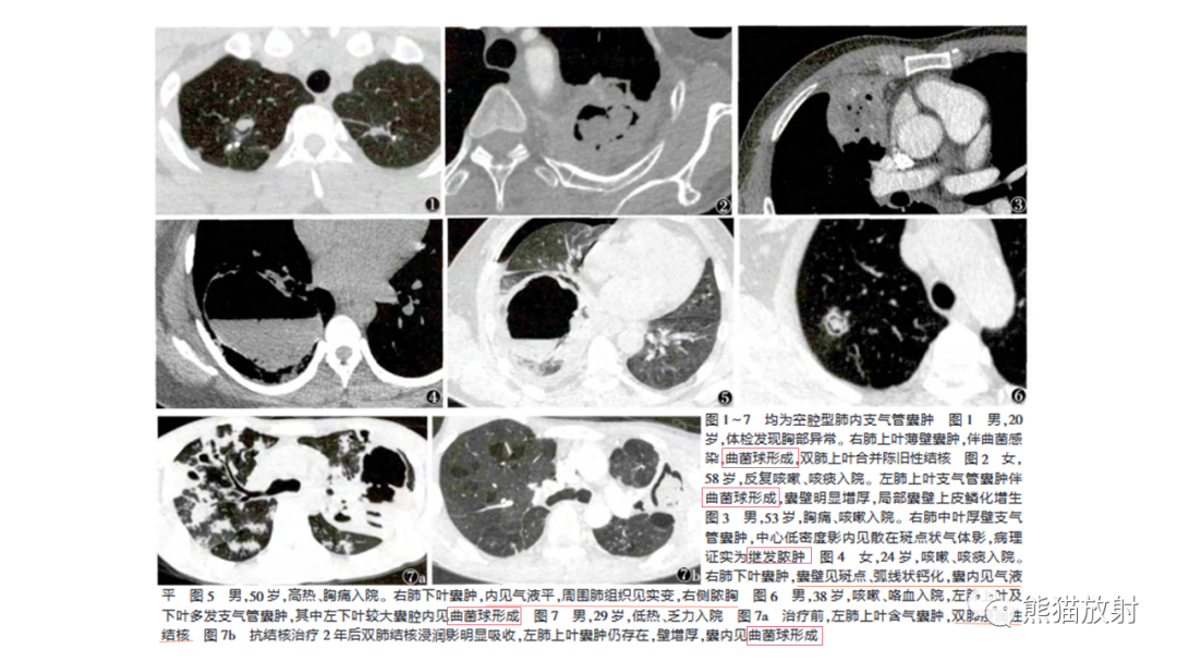 影像PPT - 【病例】支气管源性囊肿2例CT影像-32