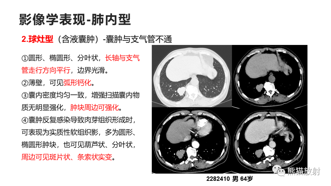 影像PPT - 【病例】支气管源性囊肿2例CT影像-33