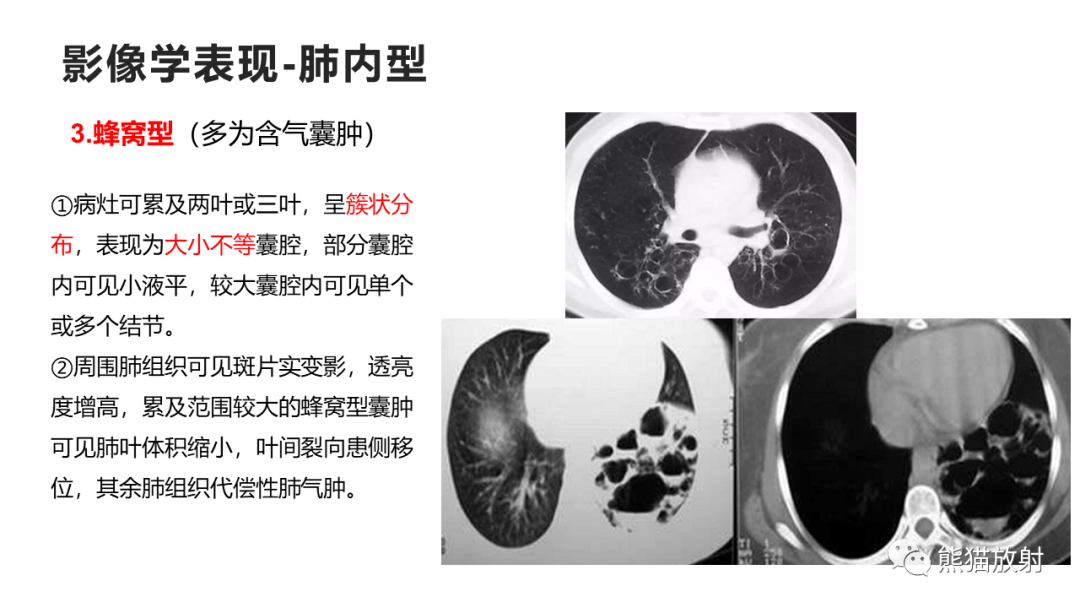 影像PPT - 【病例】支气管源性囊肿2例CT影像-34