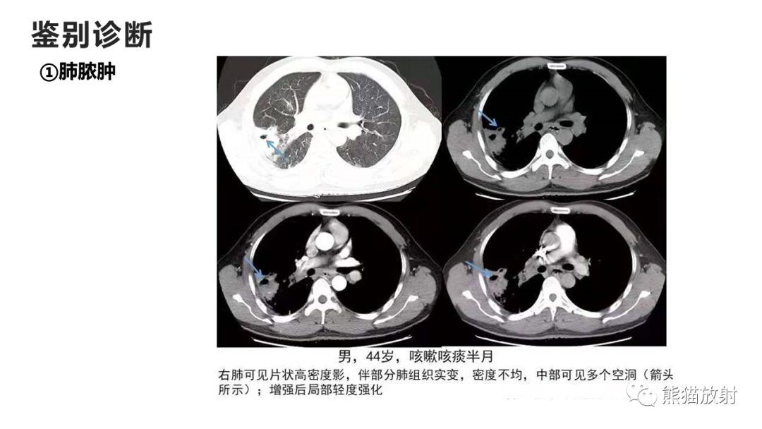 影像PPT - 【病例】支气管源性囊肿2例CT影像-36