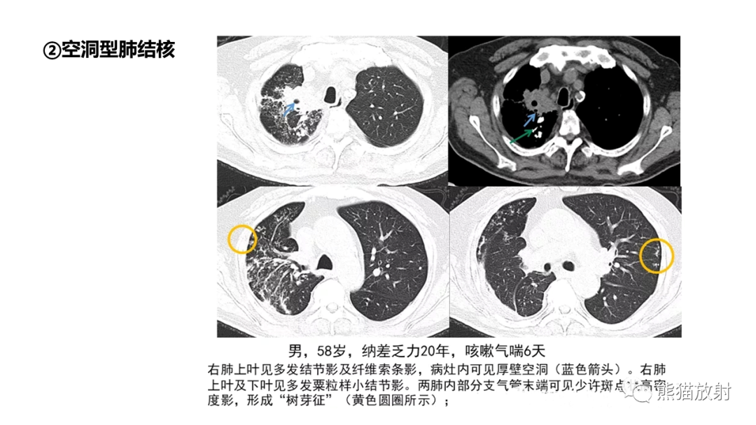 影像PPT - 【病例】支气管源性囊肿2例CT影像-38