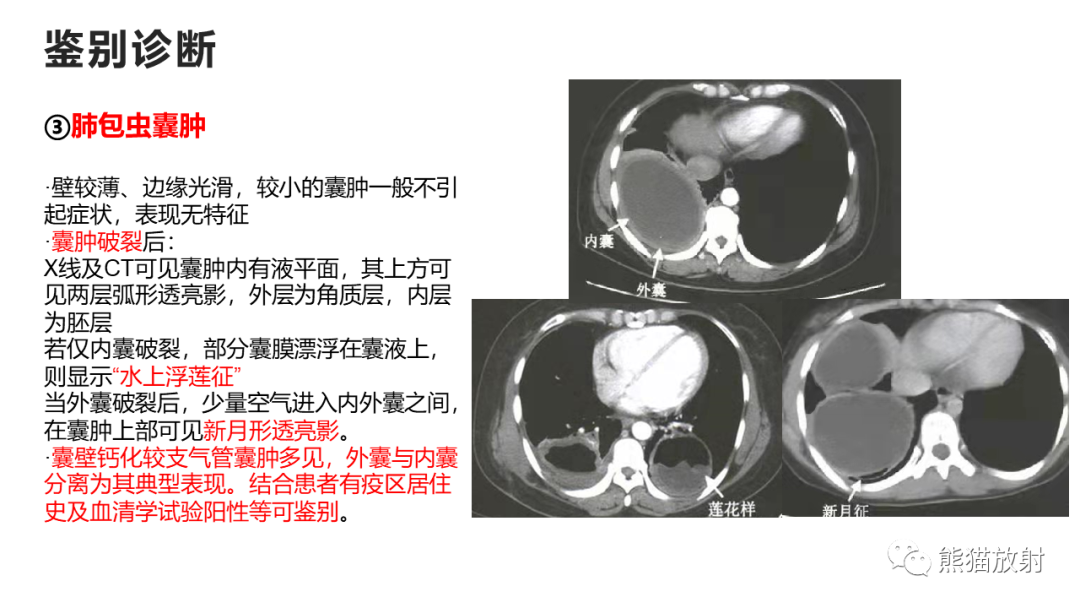 影像PPT - 【病例】支气管源性囊肿2例CT影像-39