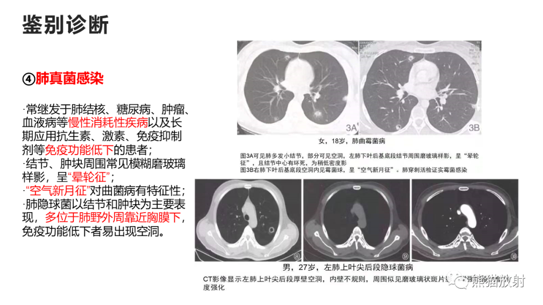 影像PPT - 【病例】支气管源性囊肿2例CT影像-40