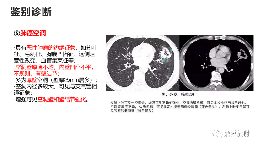 影像PPT - 【病例】支气管源性囊肿2例CT影像-41