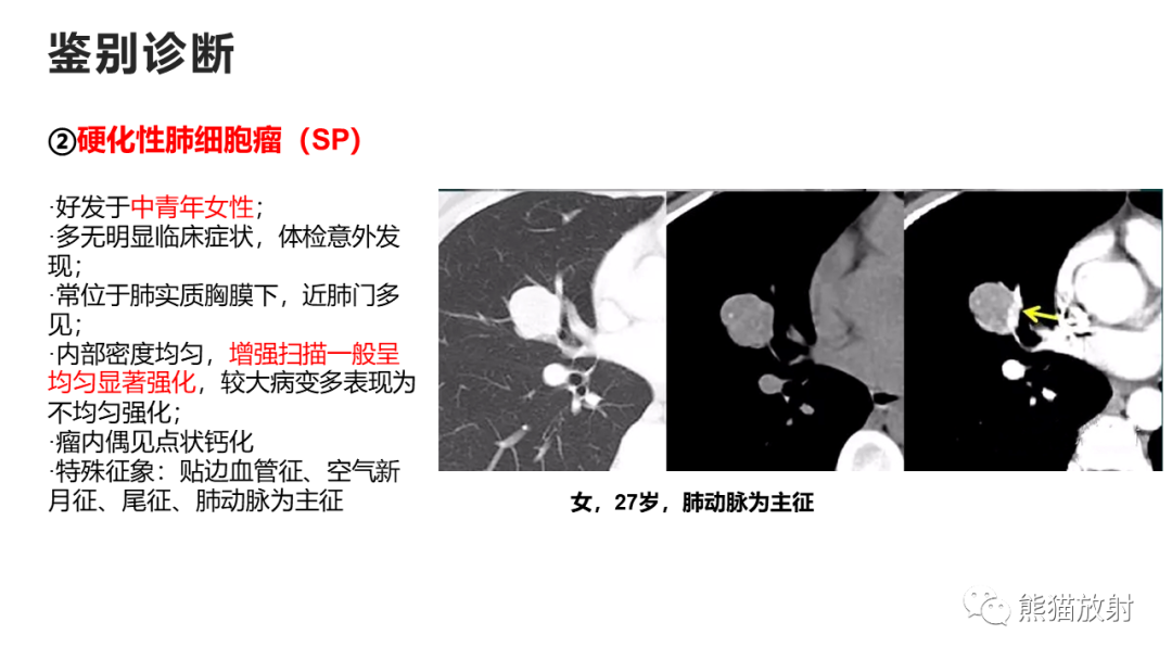 影像PPT - 【病例】支气管源性囊肿2例CT影像-44