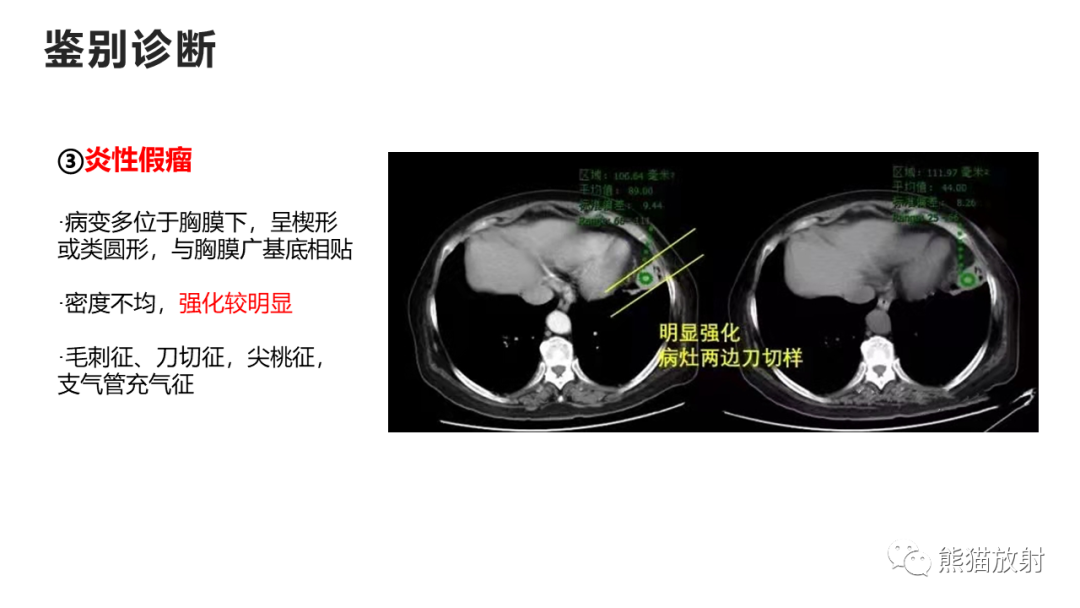 影像PPT - 【病例】支气管源性囊肿2例CT影像-45