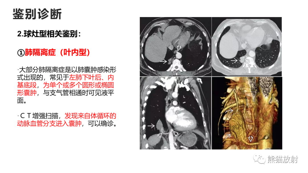 影像PPT - 【病例】支气管源性囊肿2例CT影像-43