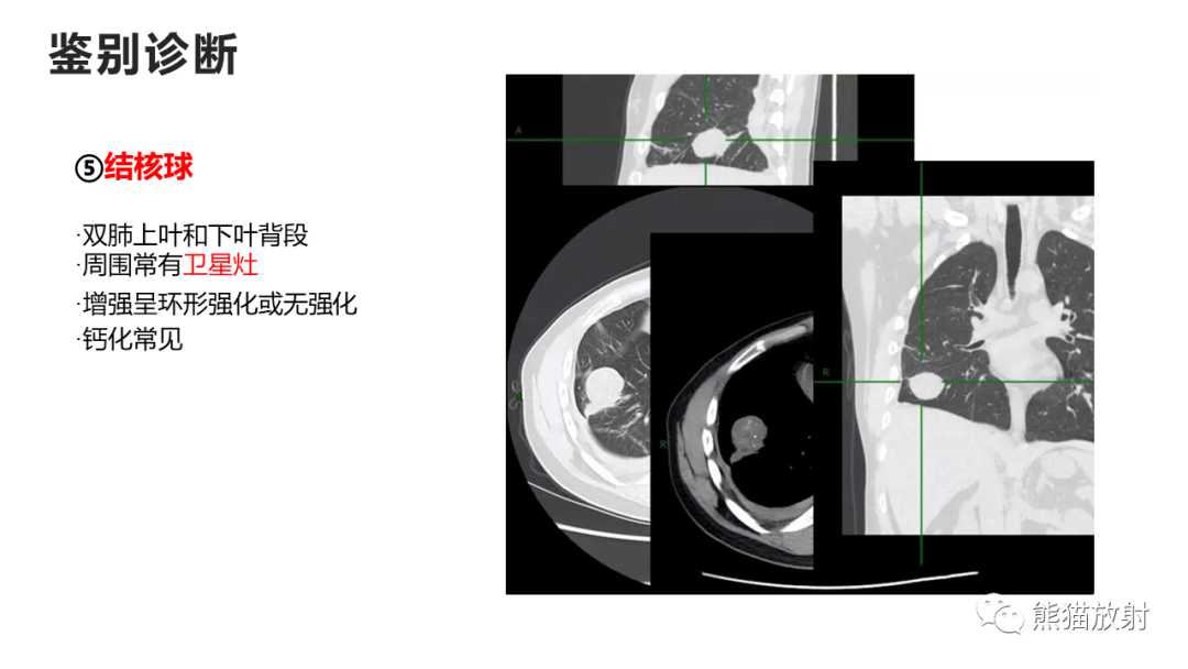 影像PPT - 【病例】支气管源性囊肿2例CT影像-47