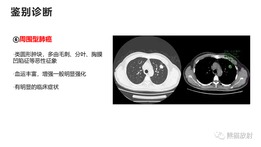 影像PPT - 【病例】支气管源性囊肿2例CT影像-48