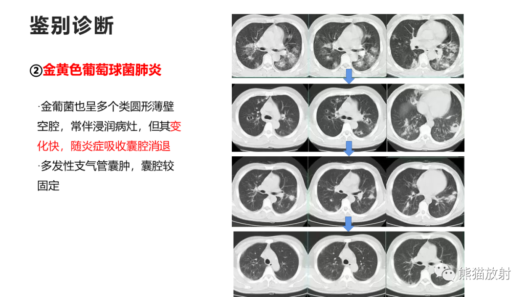 影像PPT - 【病例】支气管源性囊肿2例CT影像-51