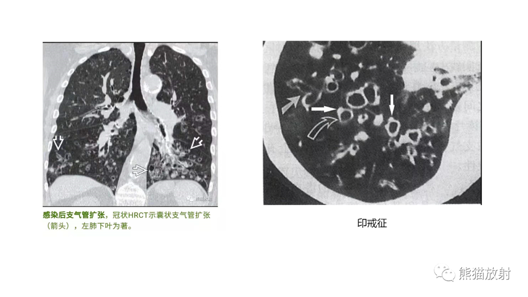 影像PPT - 【病例】支气管源性囊肿2例CT影像-50