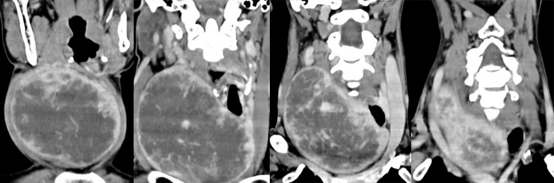 影像PPT - 5种甲状腺良性肿瘤样病变总结-2 影像PPT - 5种甲状腺良性肿瘤样病变总结-2