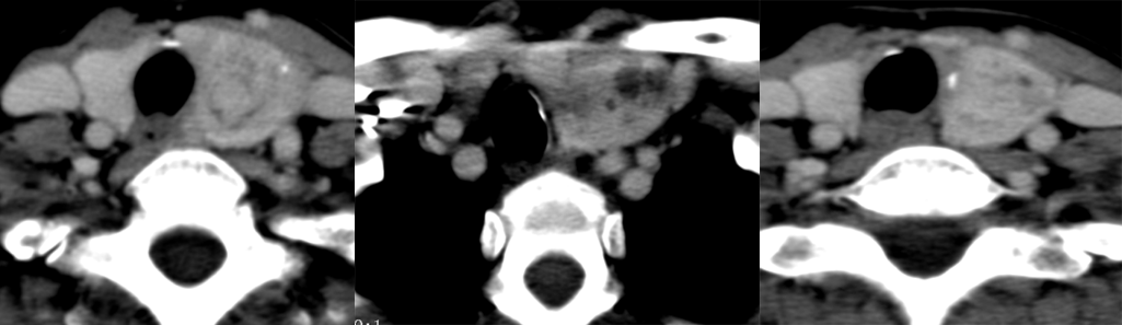 影像PPT - 5种甲状腺良性肿瘤样病变总结-6 影像PPT - 5种甲状腺良性肿瘤样病变总结-6