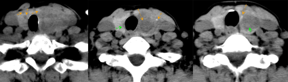 影像PPT - 5种甲状腺良性肿瘤样病变总结-4 影像PPT - 5种甲状腺良性肿瘤样病变总结-4