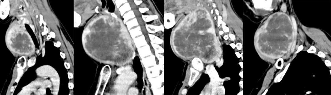 影像PPT - 5种甲状腺良性肿瘤样病变总结-3 影像PPT - 5种甲状腺良性肿瘤样病变总结-3
