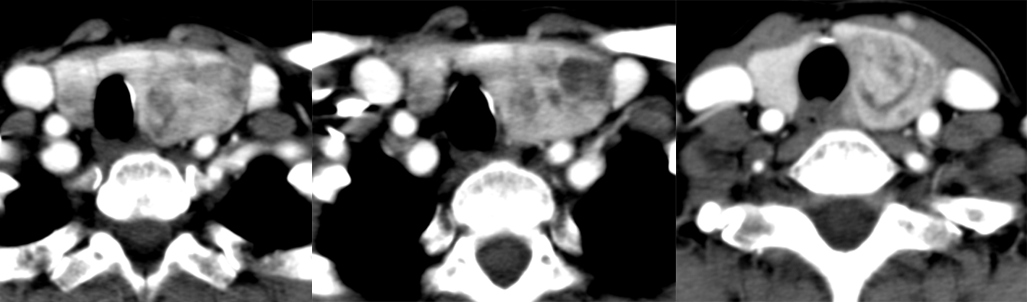 影像PPT - 5种甲状腺良性肿瘤样病变总结-5 影像PPT - 5种甲状腺良性肿瘤样病变总结-5
