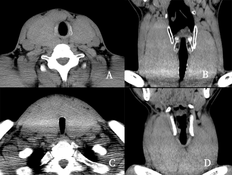 影像PPT - 5种甲状腺良性肿瘤样病变总结-7 影像PPT - 5种甲状腺良性肿瘤样病变总结-7