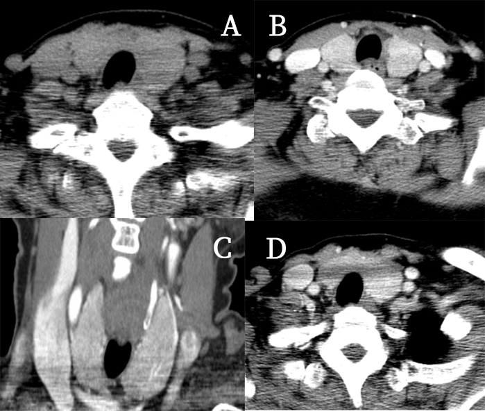 影像PPT - 5种甲状腺良性肿瘤样病变总结-8 影像PPT - 5种甲状腺良性肿瘤样病变总结-8