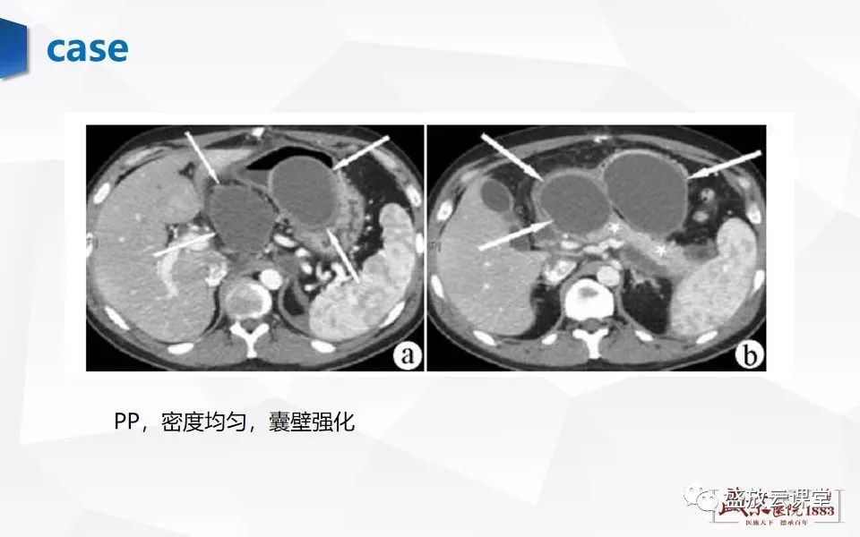 影像PPT - 【PPT】胰腺炎影像表现-15