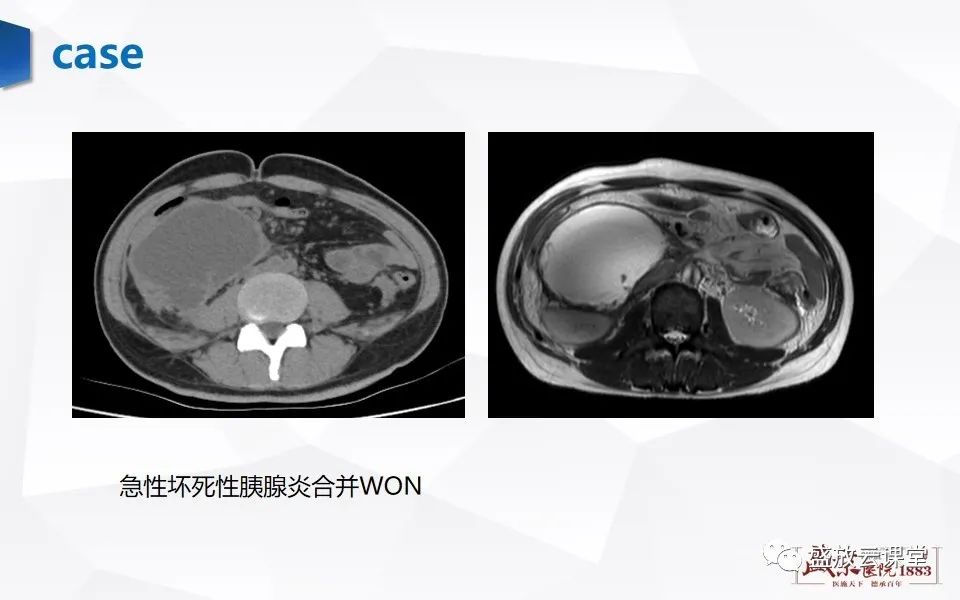 影像PPT - 【PPT】胰腺炎影像表现-22