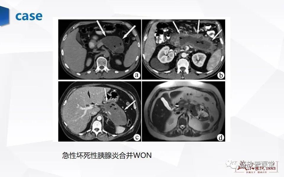 影像PPT - 【PPT】胰腺炎影像表现-24