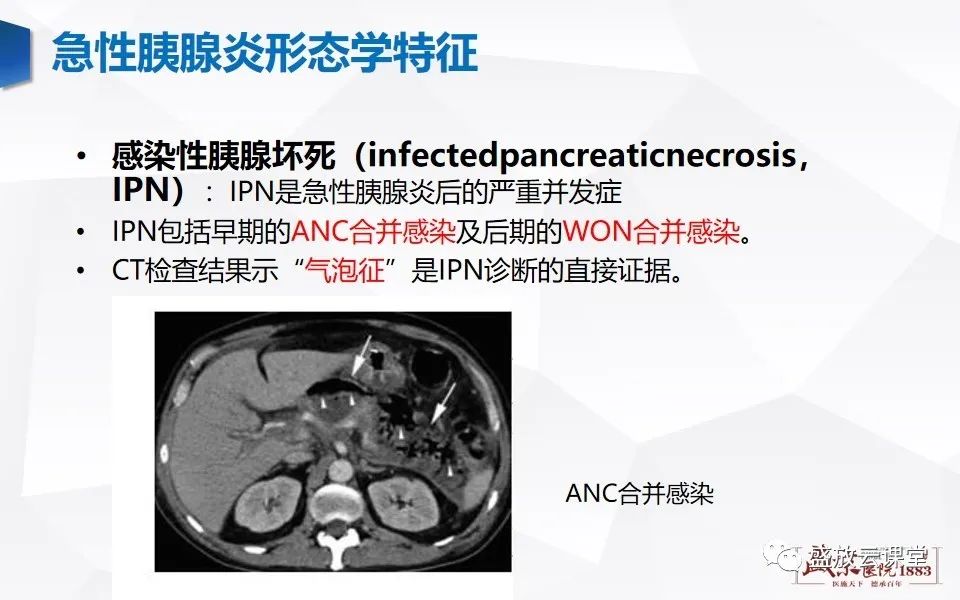 影像PPT - 【PPT】胰腺炎影像表现-28