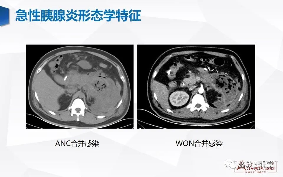 影像PPT - 【PPT】胰腺炎影像表现-29