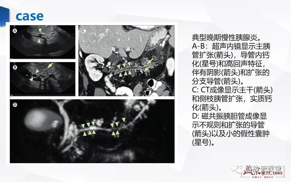 影像PPT - 【PPT】胰腺炎影像表现-42