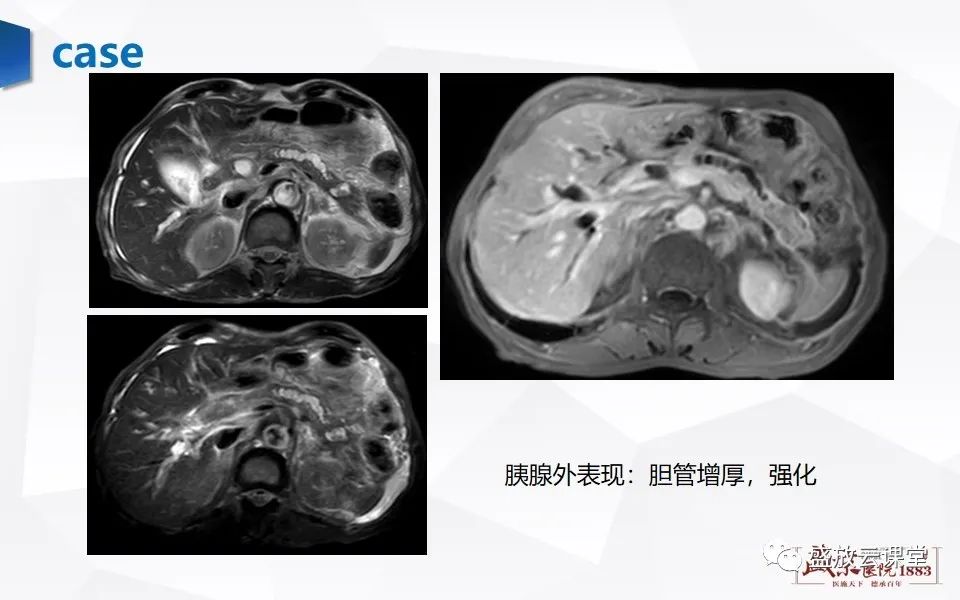影像PPT - 【PPT】胰腺炎影像表现-57