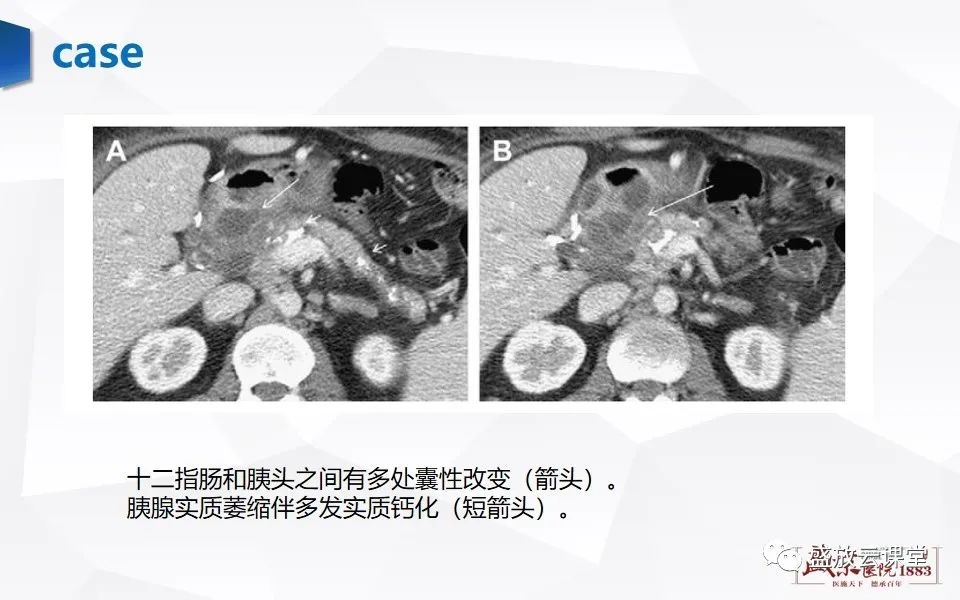 影像PPT - 【PPT】胰腺炎影像表现-62