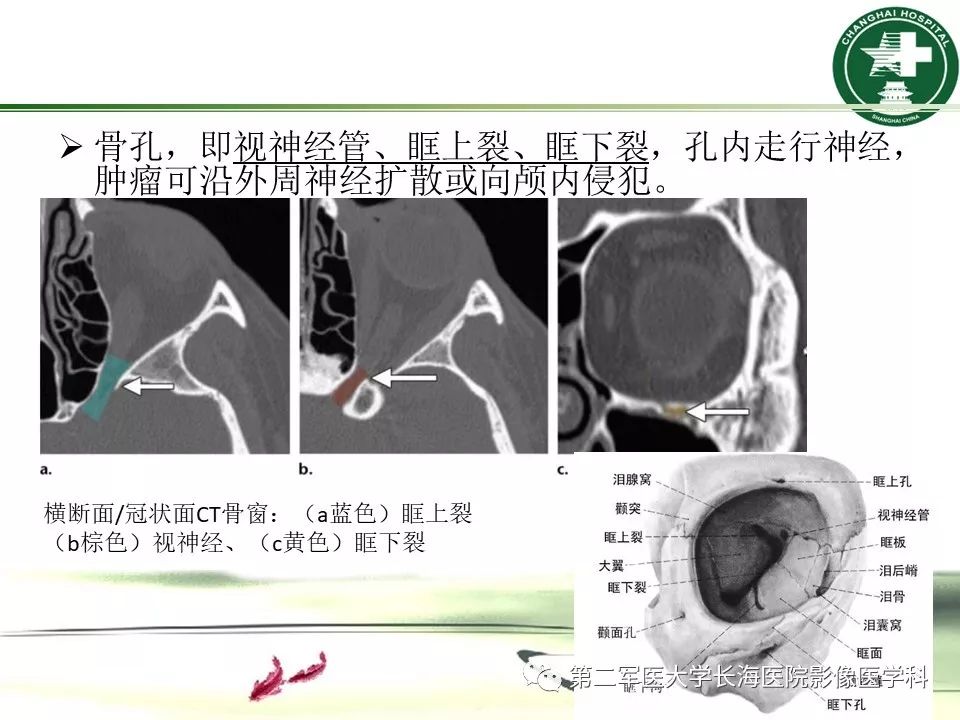 影像PPT - 【PPT】成人眼眶肿瘤：临床、影像、病理表现-7