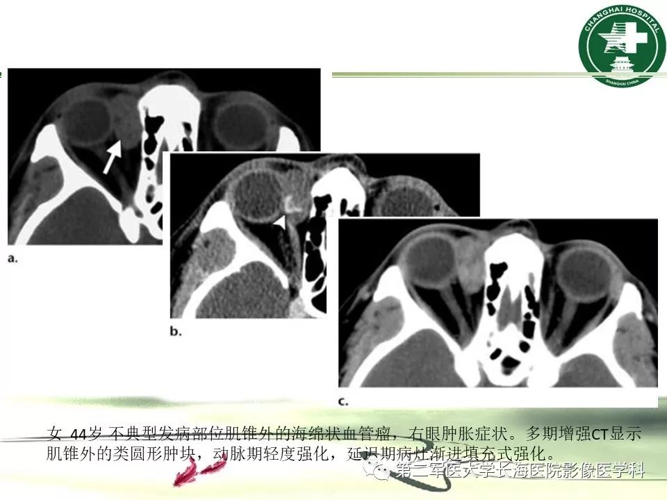 影像PPT - 【PPT】成人眼眶肿瘤：临床、影像、病理表现-15