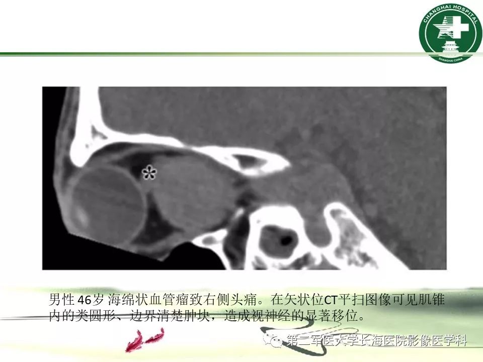 影像PPT - 【PPT】成人眼眶肿瘤：临床、影像、病理表现-13
