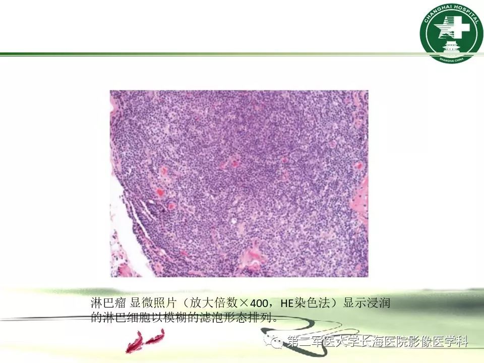 影像PPT - 【PPT】成人眼眶肿瘤：临床、影像、病理表现-18