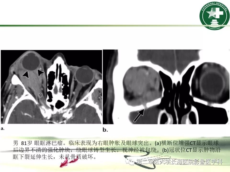 影像PPT - 【PPT】成人眼眶肿瘤：临床、影像、病理表现-20
