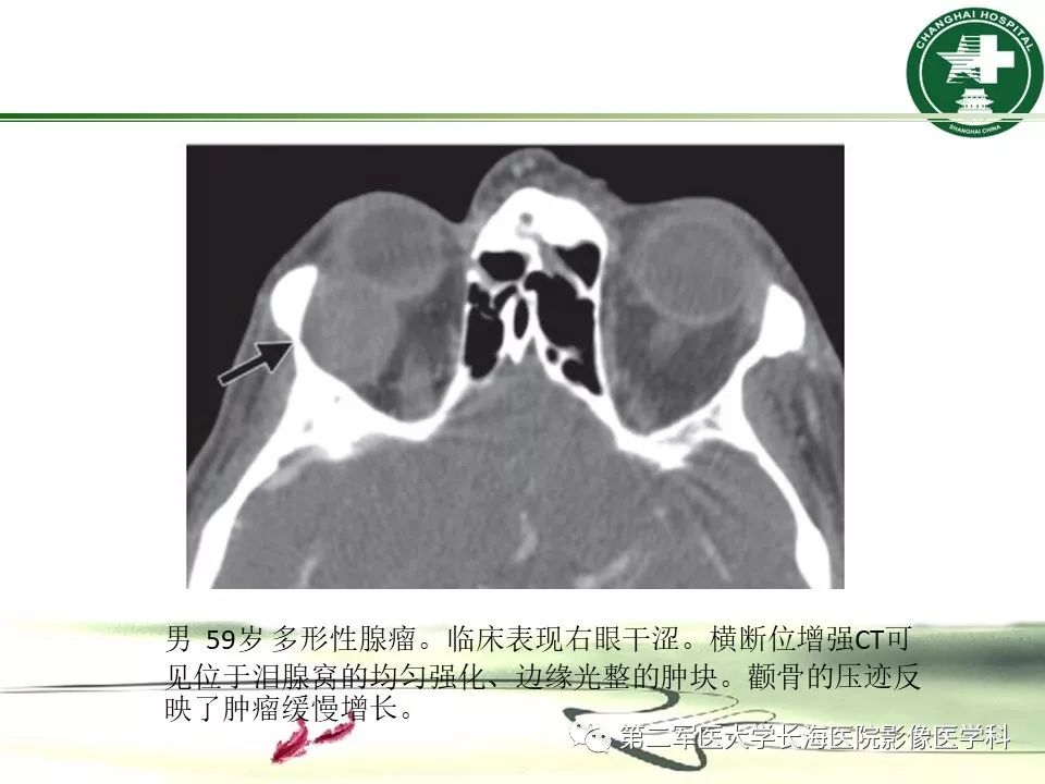 影像PPT - 【PPT】成人眼眶肿瘤：临床、影像、病理表现-26